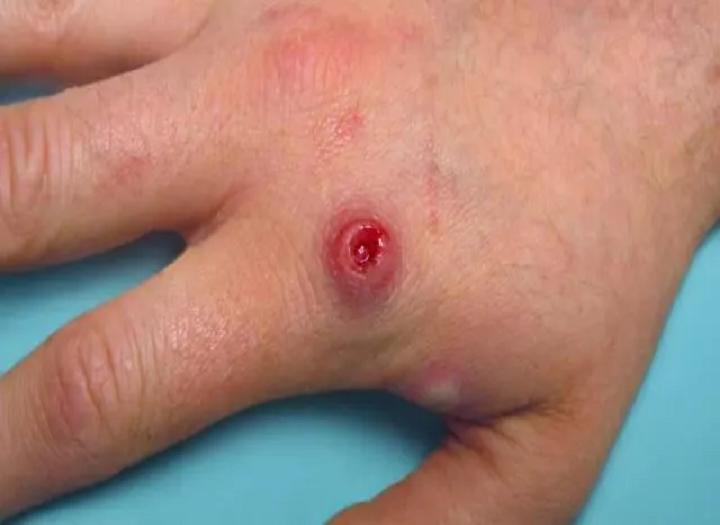 Hiểu về Monkeypox và cách ngăn chặn nó？