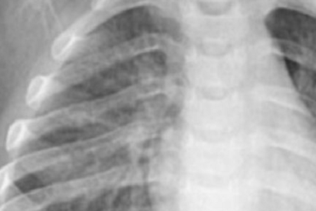 Phát hiện nhanh Pneumoniae Chlamydia: đáng tin cậy và hiệu quả